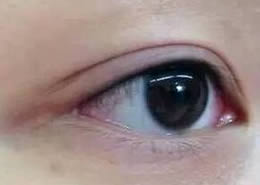 操作美瞳线后，如何让眼部更快消红退肿